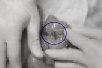 Bệnh nhi thủng ruột, sốc nhiễm khuẩn do.... nuốt phải hạt táo đỏ