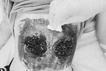 Úp bát nóng lên bụng chữa ung thư máu, nam thanh niên nguy kịch