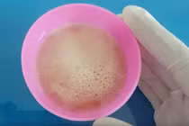 Nước tiểu có những bất thường này, cần cảnh giác 