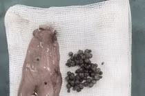 Lấy ra hơn 50 viên sỏi trong túi mật bệnh nhân 28 tuổi