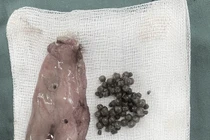 Lấy ra hơn 50 viên sỏi trong túi mật bệnh nhân 28 tuổi