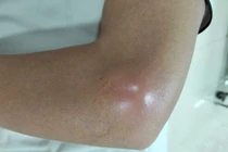 Nguy hại từ việc tiêm khớp không an toàn