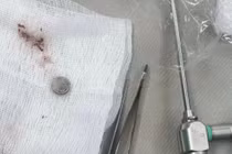 Gắp dị vật trong mũi bé trai hơn 3 tuổi: Lời cảnh tỉnh cho cha mẹ