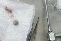 Gắp dị vật trong mũi bé trai hơn 3 tuổi: Lời cảnh tỉnh cho cha mẹ