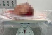 Phẫu thuật cắt bỏ khối u vú "khủng" cho nữ bệnh nhân 44 tuổi