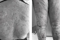 Bệnh vảy nến: Sự kỳ thị là nỗi ám ảnh