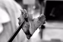 Mảnh xương "ngủ quên" trong... mũi suốt 10 tháng