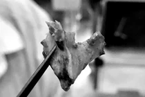 Mảnh xương "ngủ quên" trong... mũi suốt 10 tháng