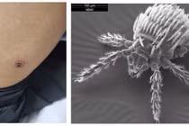 Người đàn ông 48 tuổi bị suy hô hấp do ve mò cắn