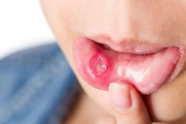 7 loại đồ uống giúp xua tan nhiệt miệng, làm dịu vết loét