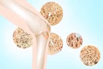 Người bị bệnh loãng xương nên kiêng gì?