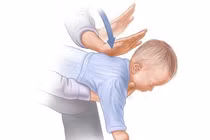 Cứu bệnh nhi 9 tháng tuổi ngừng hô hấp tuần hoàn do sặc cháo