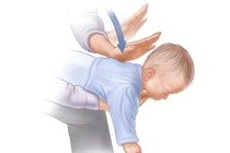 Cứu bệnh nhi 9 tháng tuổi ngừng hô hấp tuần hoàn do sặc cháo