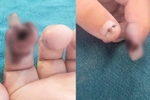 Bé gái 3 tuổi bị đứt rời búp ngón tay do kẹp vào cửa siêu thị