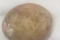 Bí tiểu, người đàn ông 64 tuổi đi khám thì phát hiện "núi sỏi khổng lồ"