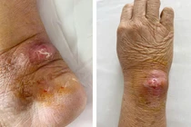 Nhiều người nhập viện vì mèo cào, sơ cứu vết thương thế nào?