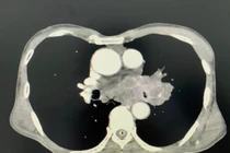 Mệt mỏi, sút cân, đi khám bất ngờ phát hiện u phổi ác tính