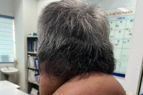 Mắc bệnh "người gấu" vì... nghiện rượu lâu năm