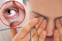 "Điểm" 4 bệnh mắt thường gặp vào mùa mưa, cần lưu ý
