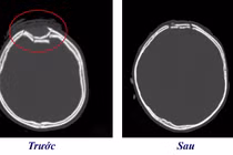 Bé 3 tuổi bị chấn thương sọ não do... vô tình vặn tay ga xe máy