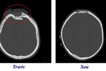 Bé 3 tuổi bị chấn thương sọ não do... vô tình vặn tay ga xe máy