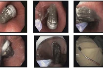 Nữ sinh vô tình nuốt... bàn chải dài 15cm vào bụng