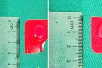 Viên thuốc còn nguyên vỏ cắm sâu trong thực quản người phụ nữ 54 tuổi