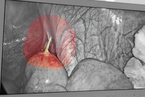 Thủng hồi tràng do... thói quen ngậm tăm sau ăn