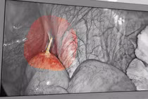 Thủng hồi tràng do... thói quen ngậm tăm sau ăn