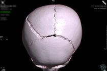 Bé gái 15 tháng tuổi bị cổng sắt đổ sập vào đầu gây chấn thương nặng