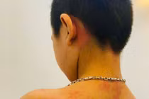 Uống 11 loại thuốc để chữa ho, bé trai 7 tuổi sốc phản vệ nguy kịch