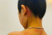 Uống 11 loại thuốc để chữa ho, bé trai 7 tuổi sốc phản vệ nguy kịch