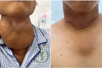 Thanh niên bị khối bướu giáp nặng 600gr chèn ép đường thở, không thể cúi đầu