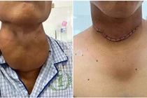 Thanh niên bị khối bướu giáp nặng 600gr chèn ép đường thở, không thể cúi đầu