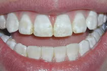 Top thực phẩm có thể "bào mòn" men răng không phải ai cũng biết