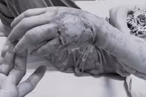 Chủ quan với nốt phồng nhỏ, người phụ nữ suýt mất bàn tay