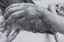 Chủ quan với nốt phồng nhỏ, người phụ nữ suýt mất bàn tay