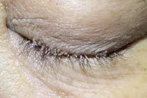 Rận bám chi chít trên mi mắt người phụ nữ 50 tuổi