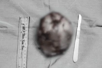 Ngực to bất thường, cô gái đi khám phát hiện khối u "khủng"