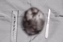 Ngực to bất thường, cô gái đi khám phát hiện khối u "khủng"