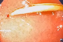 Thủng tá tràng vì... thói quen ngậm tăm sau ăn