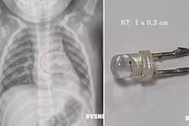 Gắp dị vật trong đường thở bé 10 tháng tuổi