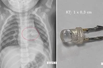 Gắp dị vật trong đường thở bé 10 tháng tuổi