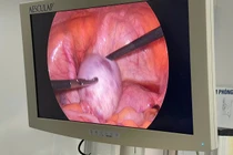 Đau bụng âm, mệt mỏi, đi khám phát hiện u nang buồng trứng xoắn