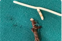 Vòng tránh thai "đi lạc" trong bụng cụ bà 40 năm