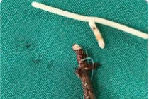 Vòng tránh thai "đi lạc" trong bụng cụ bà 40 năm