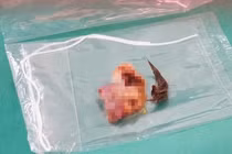 Cắt bỏ khối u quái buồng trứng chứa đầy lông cho nữ bệnh nhân 36 tuổi