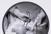 Phẫu thuật lấy thai “giải quyết” u quái buồng trứng cho sản phụ