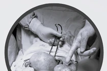 Phẫu thuật lấy thai “giải quyết” u quái buồng trứng cho sản phụ