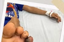 Không nên tự ý chữa rắn cắn bằng thuốc nam chưa được kiểm chứng